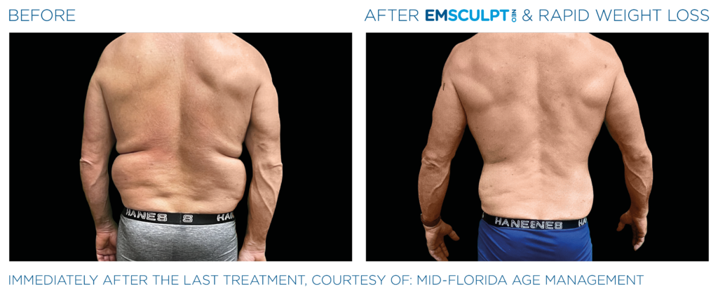 Emsculpt_Neo-Weight-Loss_PIC_Ba-card-male-lateral-abdomen-011_ENUS100