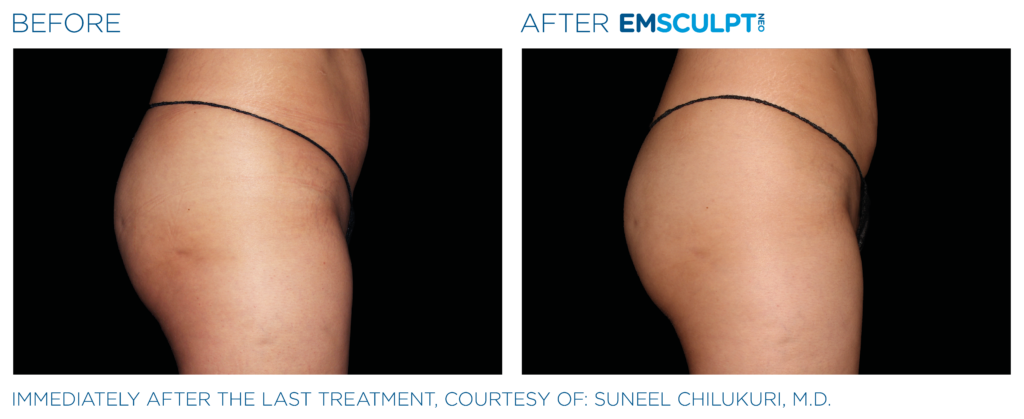 Emsculpt_Neo_PIC_Ba-card-female-buttock-076_ENUS100