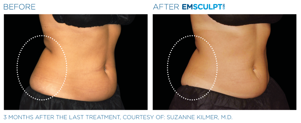 Emsculpt_Neo_PIC_Ba-card-female-lateral-abdomen-178_ENUS100