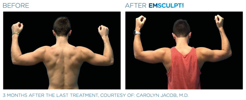 Emsculpt_Neo_PIC_Ba-card-male-arms-077-B_ENUS100
